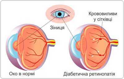 Діабетична ретинопатія. Лікування. Кременчук.