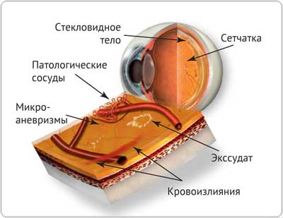 Офтальмологический центр ОКУЛЮС. Диабетическая ретинопатия. Лечение и диагностика.