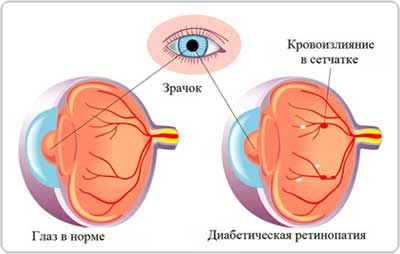 Диабетическая ретинопатия. Лечение. Кременчуг.