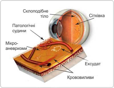 Офтальмологічний центр ОКУЛЮС. Діабетична ретинопатія. Лікування та діагностика.