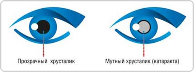 Лечение катаракты. Офтальмологический центр ОКУЛЮС. Кременчуг.