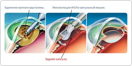 Операционное лечение катаракты. Офтальмологический центр ОКУЛЮС. Кременчуг.